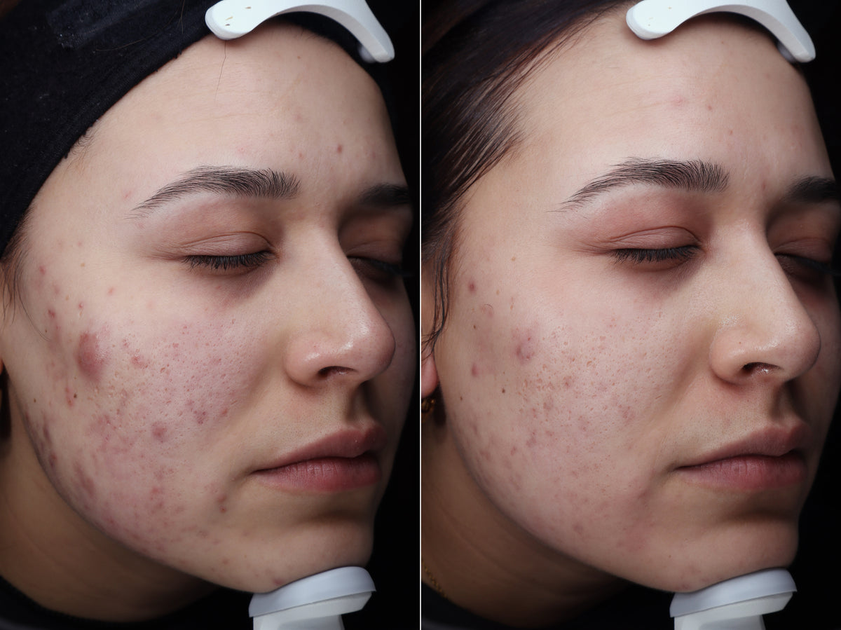 A VELA client before and after acne treatment, with far less redness and fewer active breakouts
