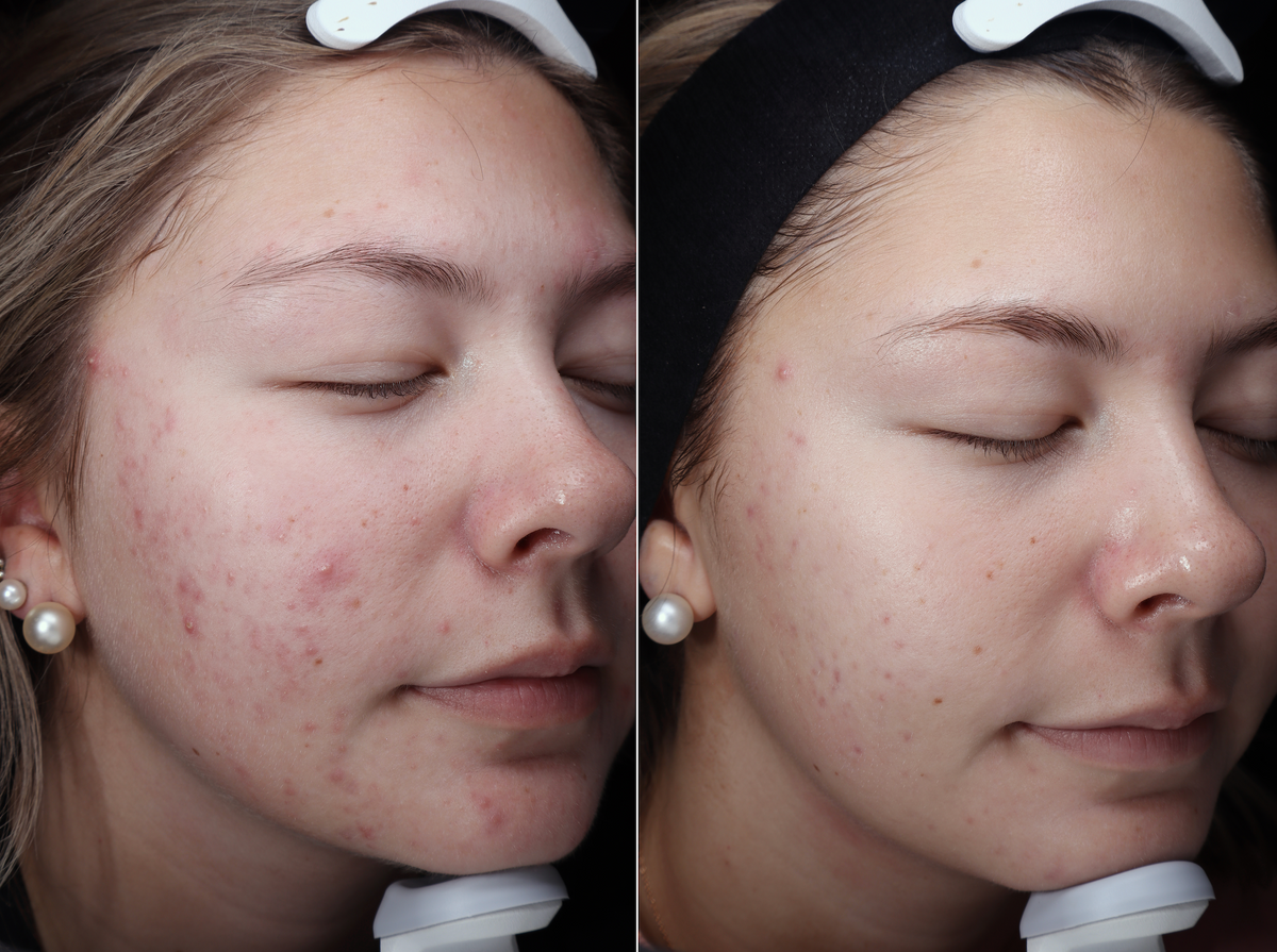 A VELA client before and after treatment, with inflamed breakouts cleared and forehead pigment fading