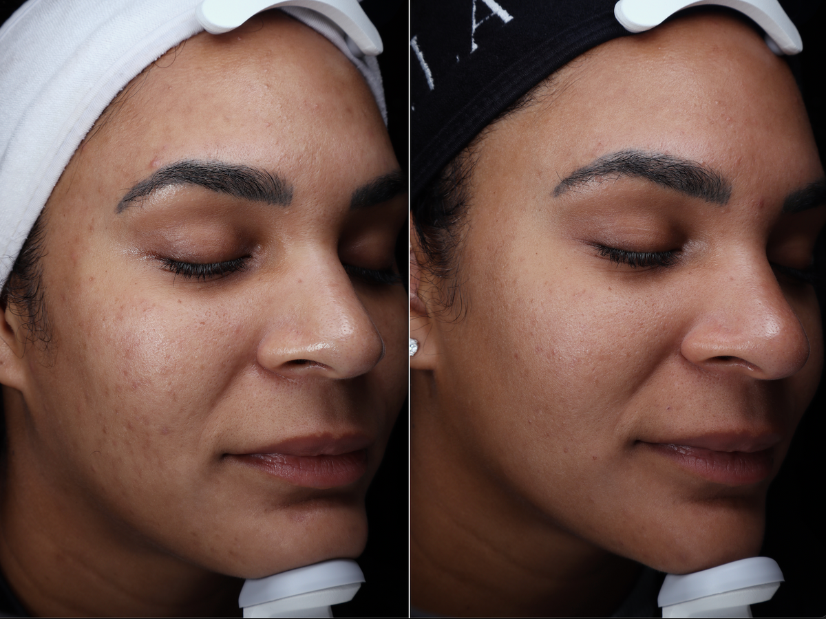A VELA client before and after treatment, with dark spots faded and a smoother complexion