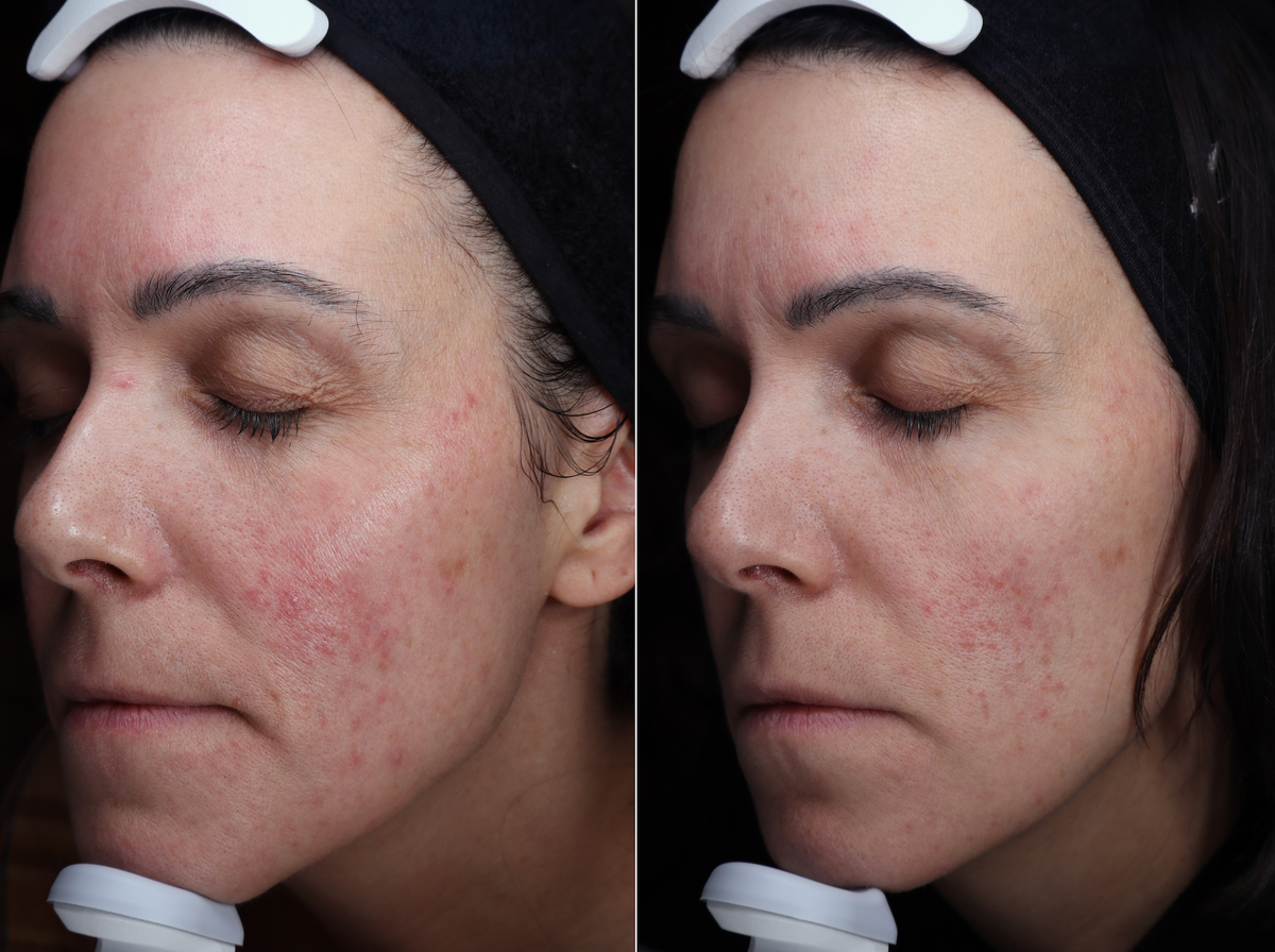 A VELA client with a deeper skin tone before and after treatment, with smoother texture and fewer breakouts