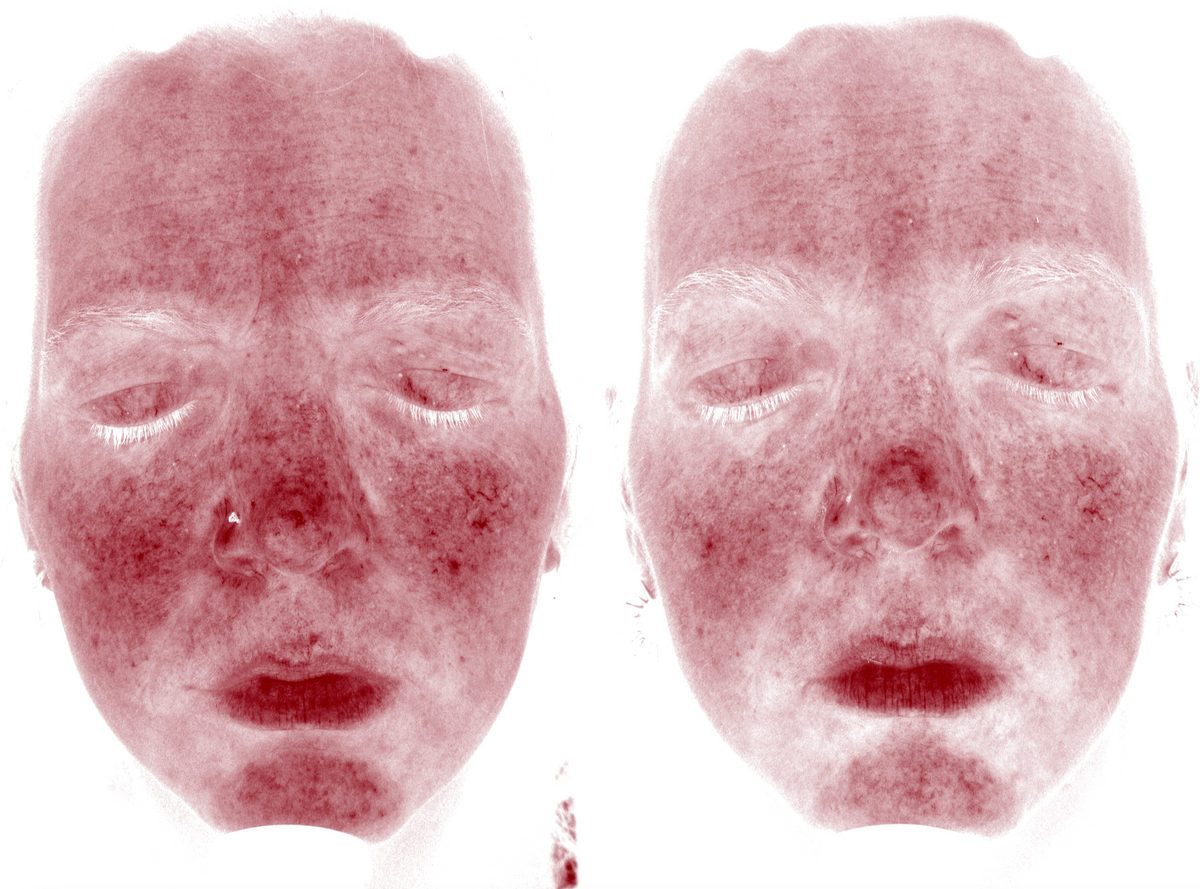 A VELA client before and after treatment, with calmer redness and a more even tone
